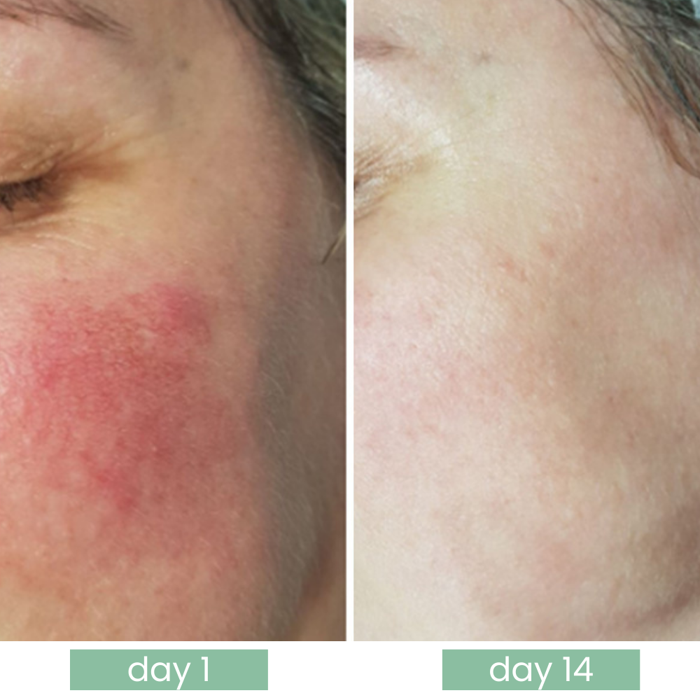 Calmora Azelaic Acid 10%