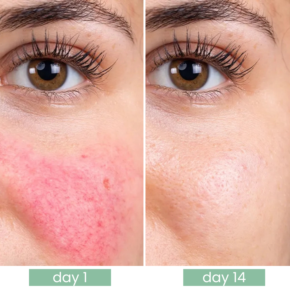 Calmora Azelaic Acid 10%